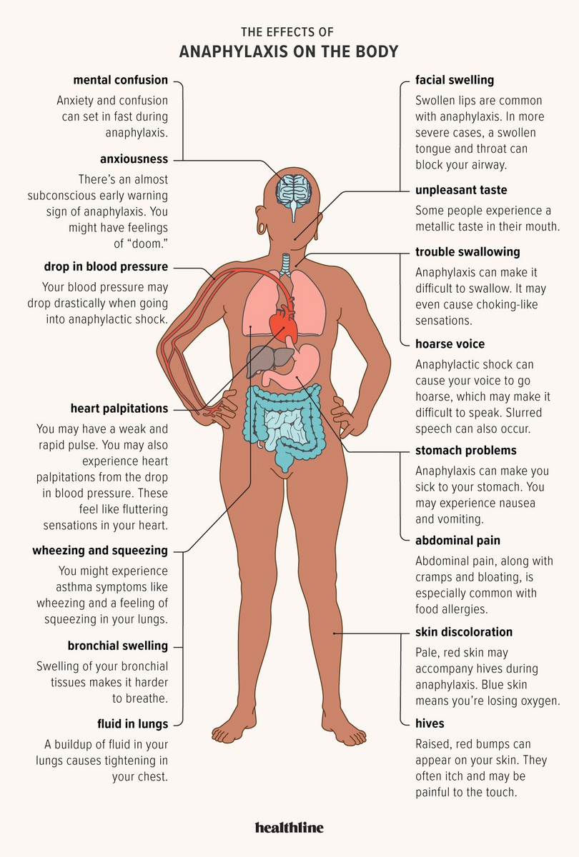 15 Effects Of Anaphylaxis On The Body