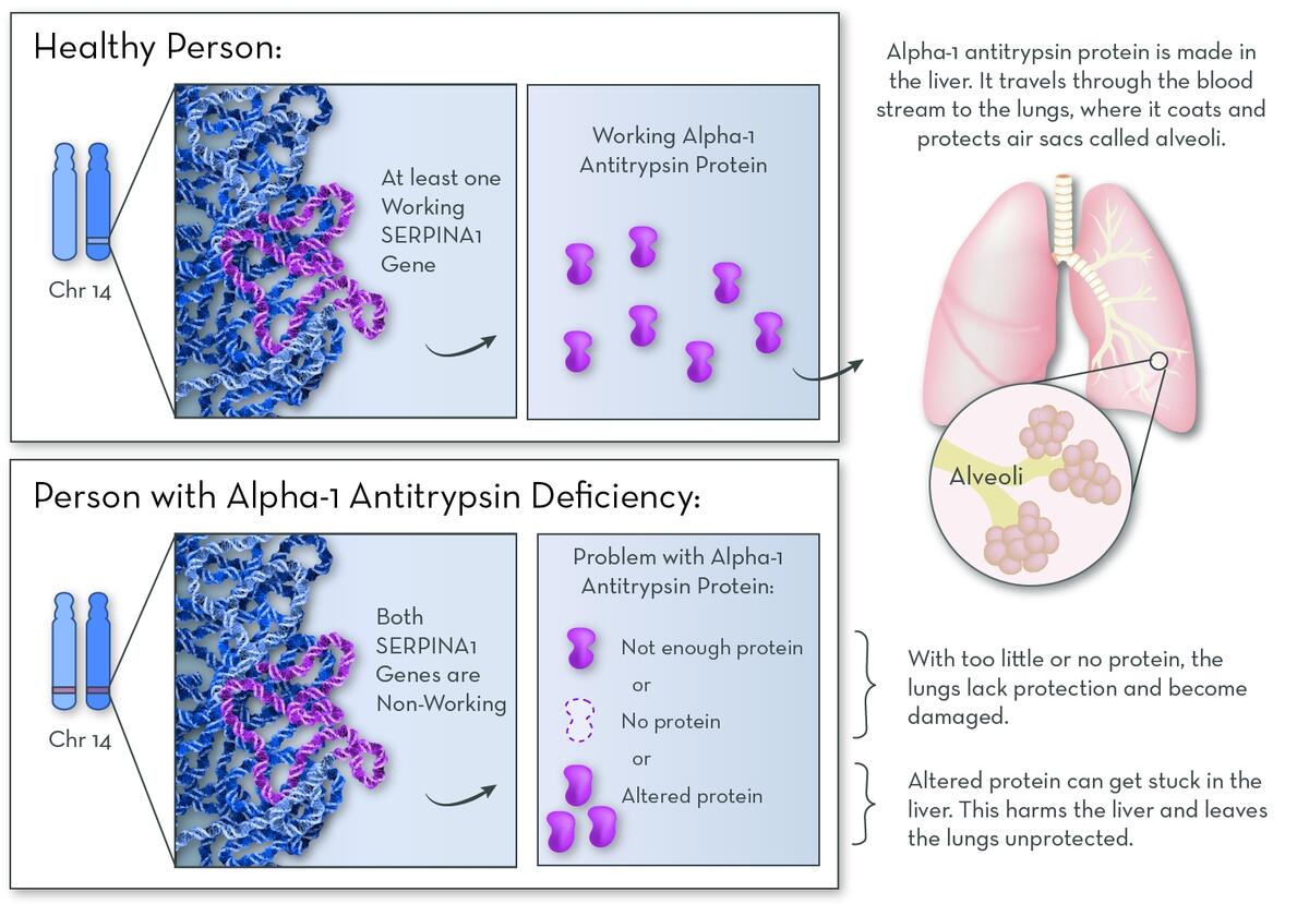 Alpha 1 Antitrypsin Deficiency