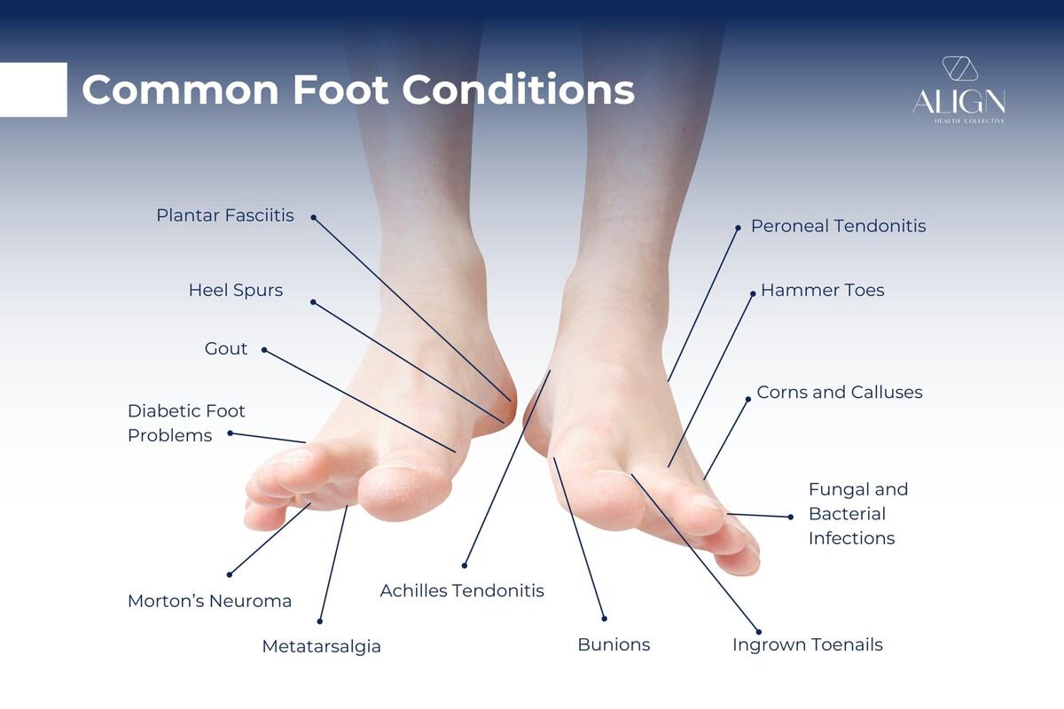 Common Foot Conditions Foot Pain Types Causes AlignHC