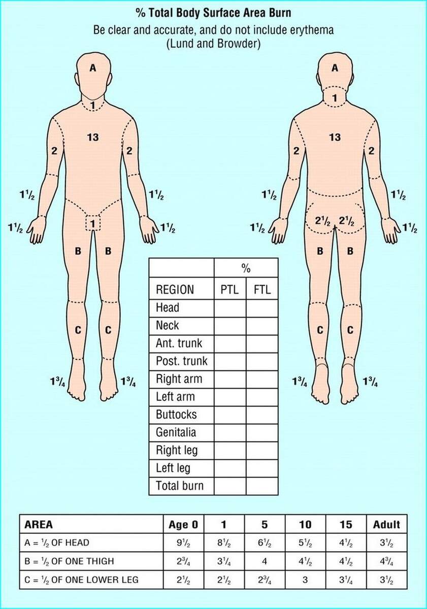 Parkland Formula For Burns