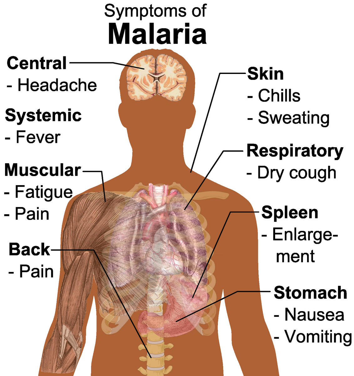 File Symptoms Of Malaria Png Wikimedia Commons