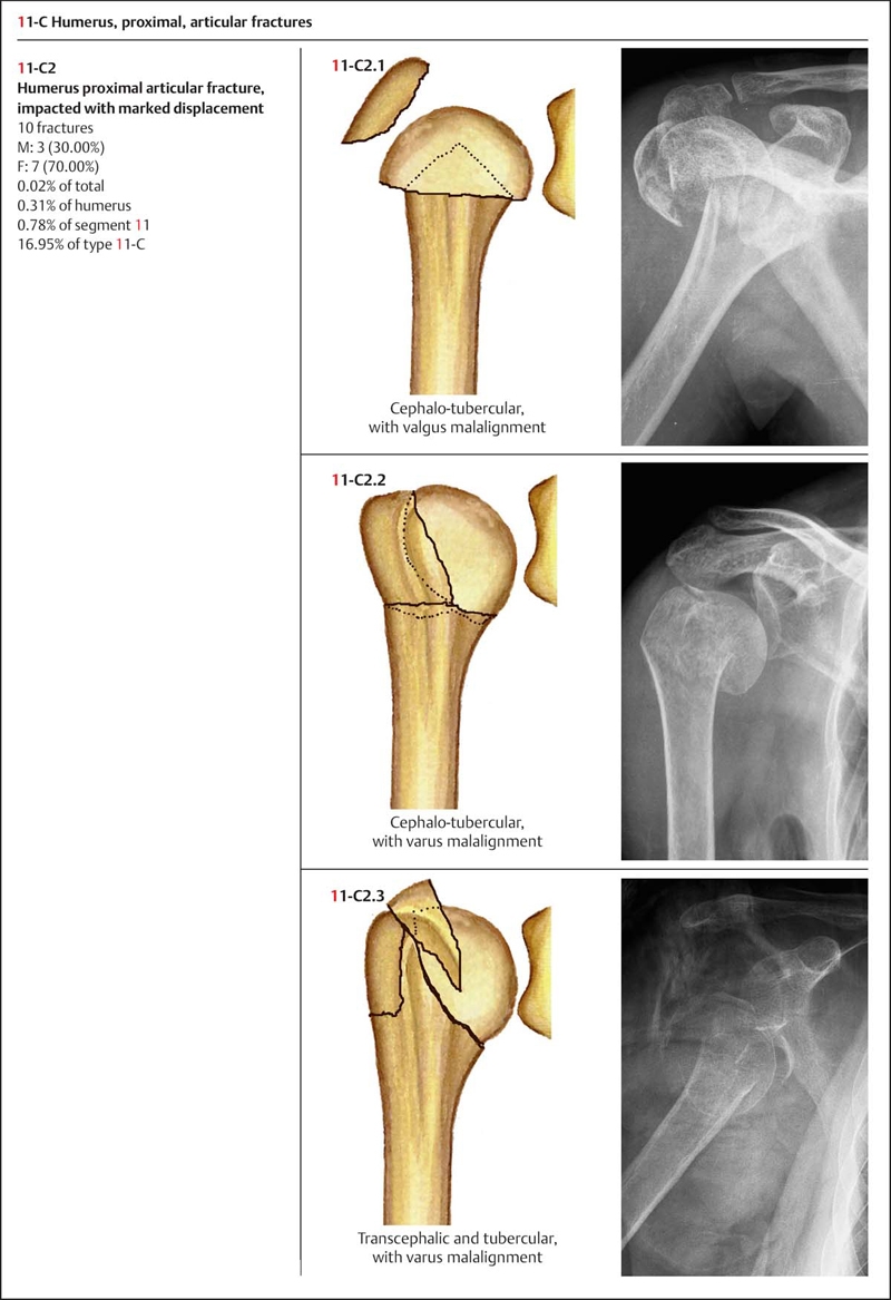 Fractures Of The Humerus Musculoskeletal Key