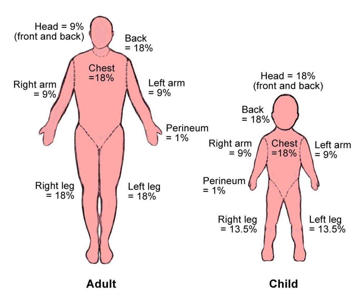 How To Recognize And Treat 6 Degrees Of Burns HubPages