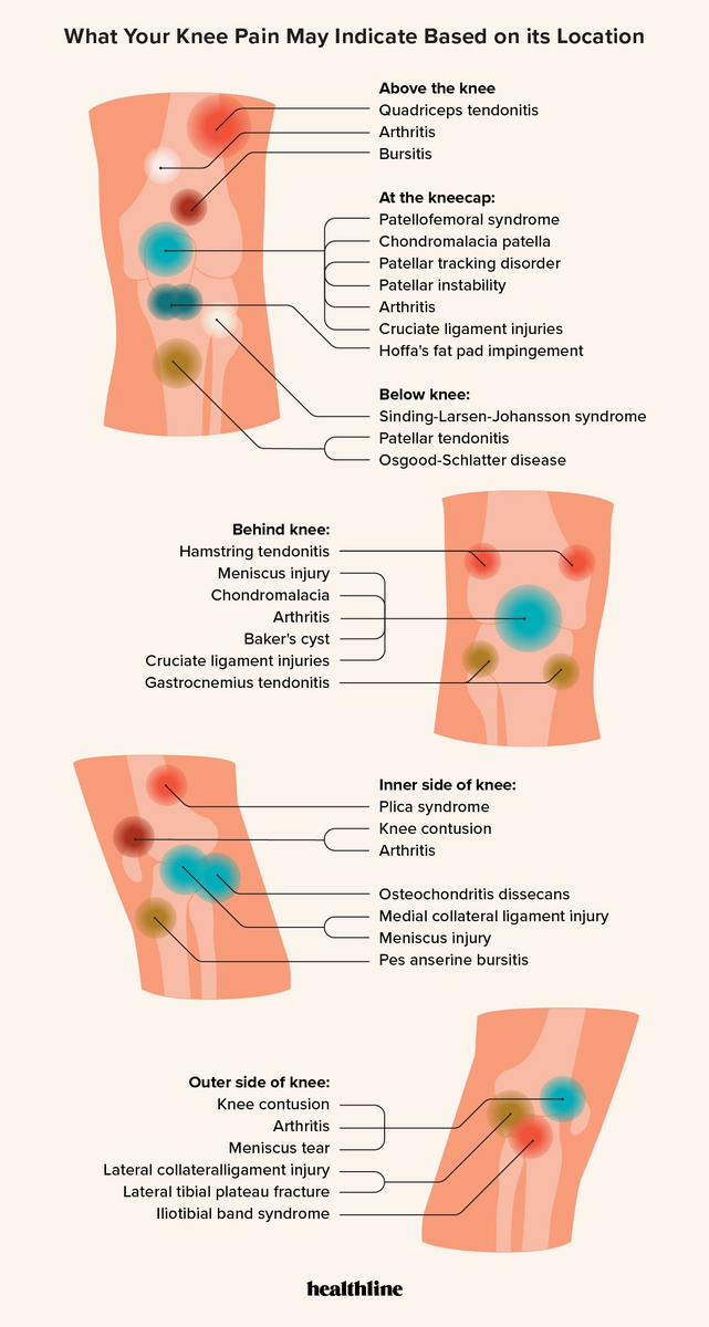 Knee Pain Location Chart What Knee Pain May Indicate