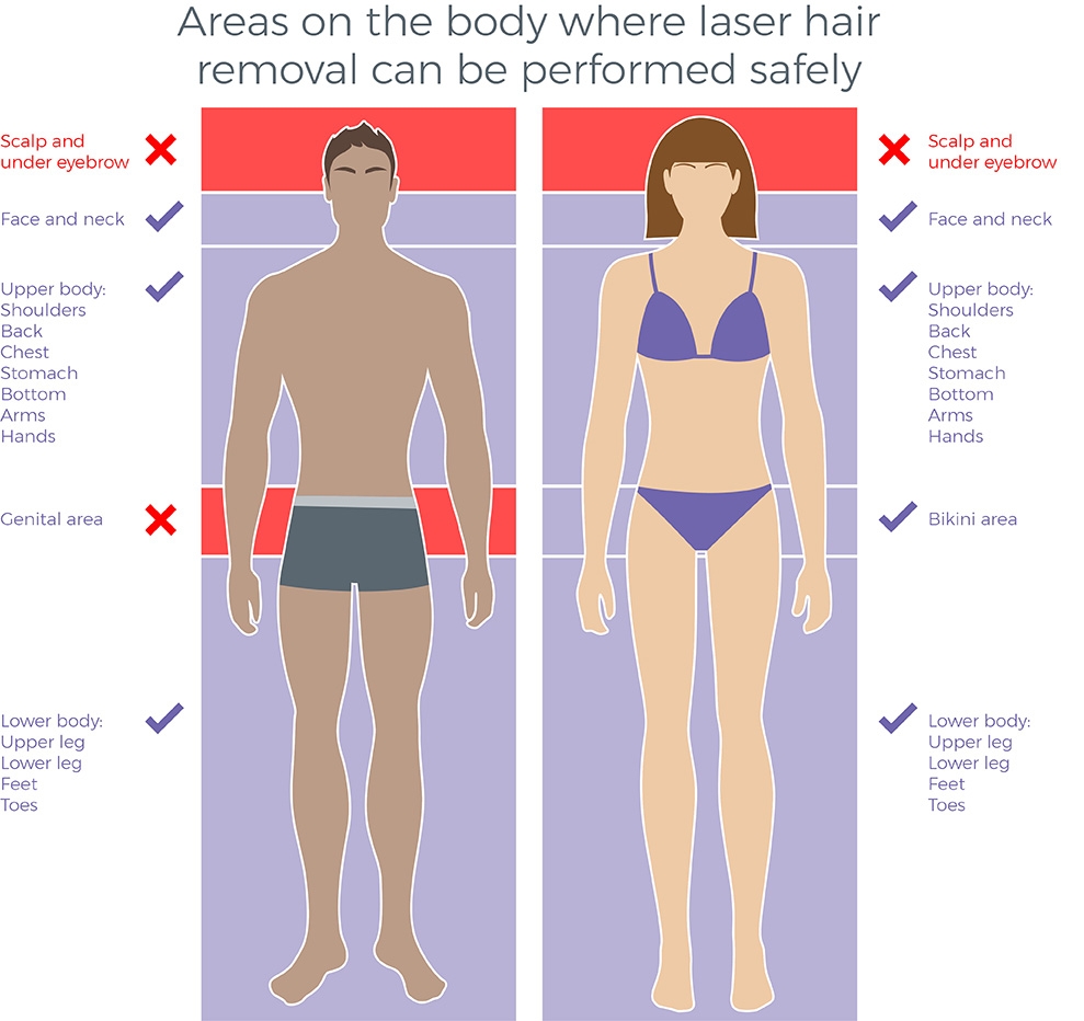 Laser Hair Removal Avance Clinic