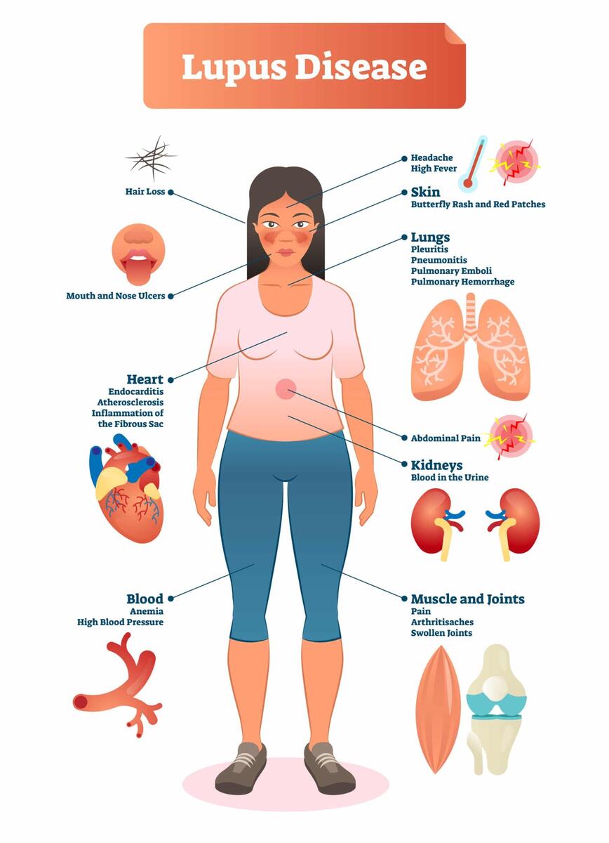 Health Disparities In Lupus Lupus Foundation Of America