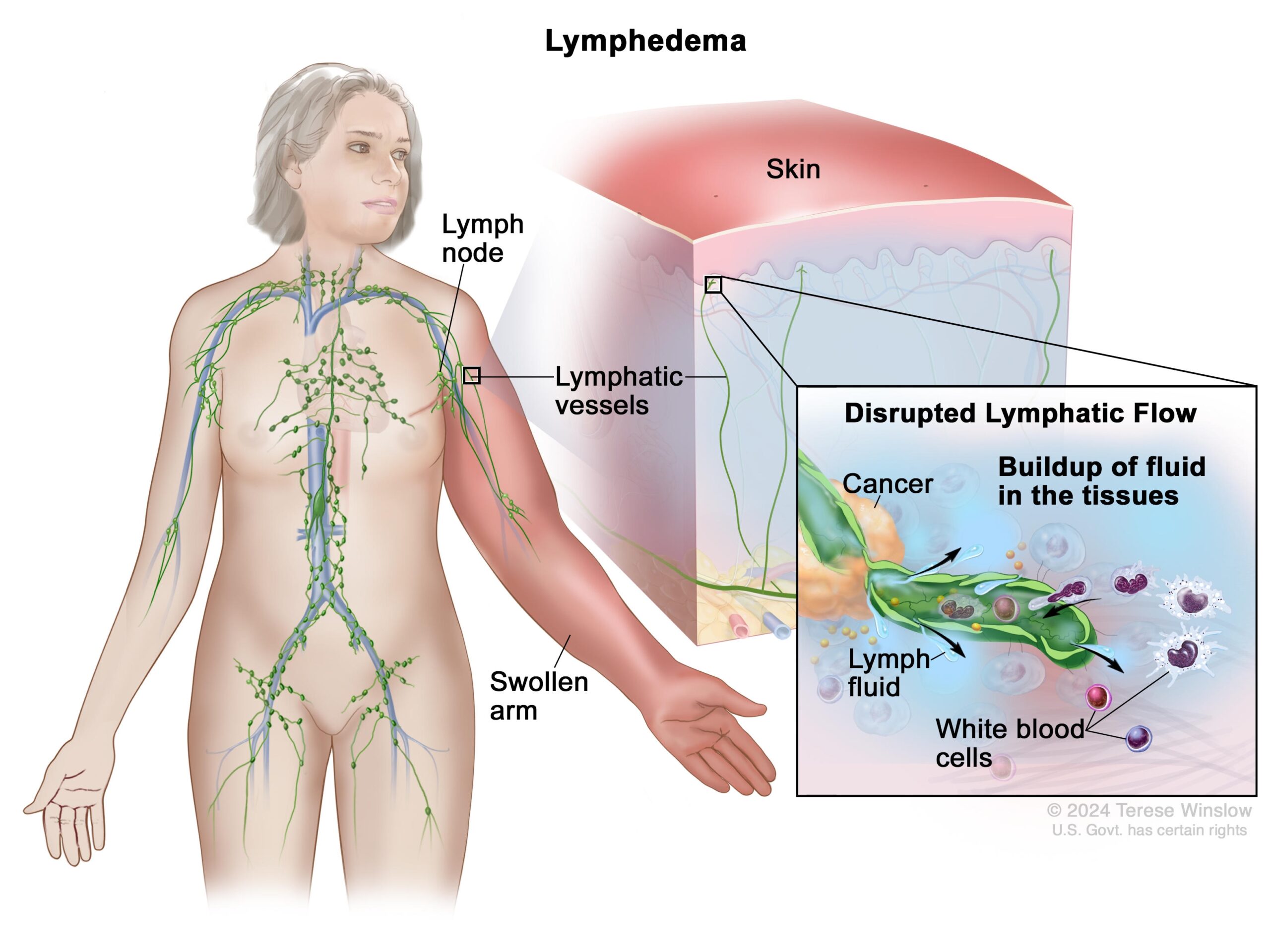 Lymphedema And Cancer Side Effects NCI