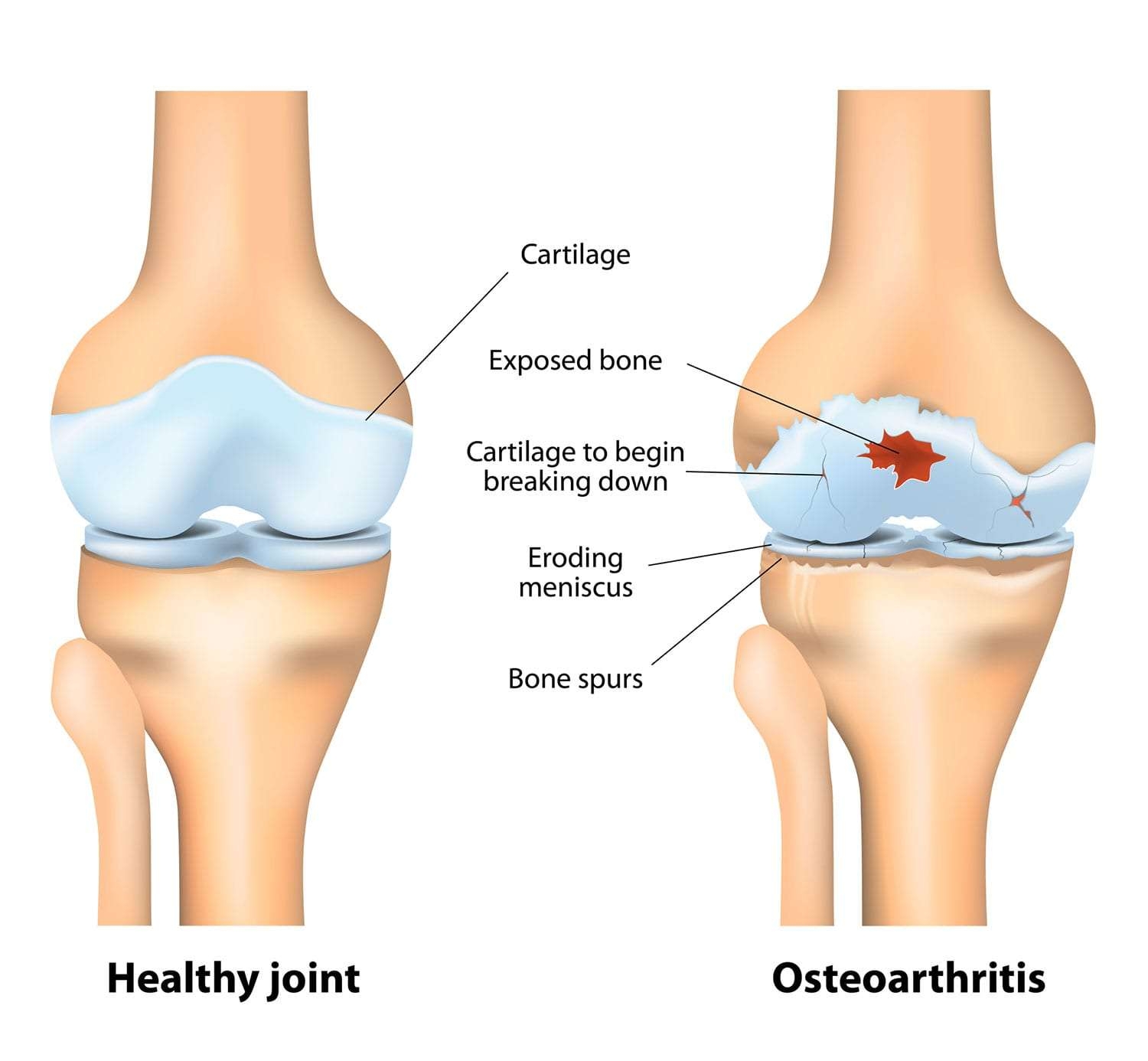 Osteoarthritis Causes Symptoms And Treatment Options