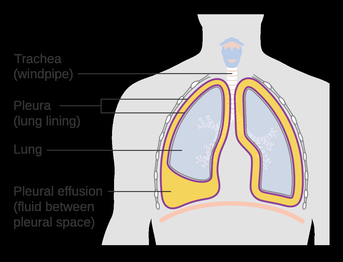 Pleural Effusion Wikipedia