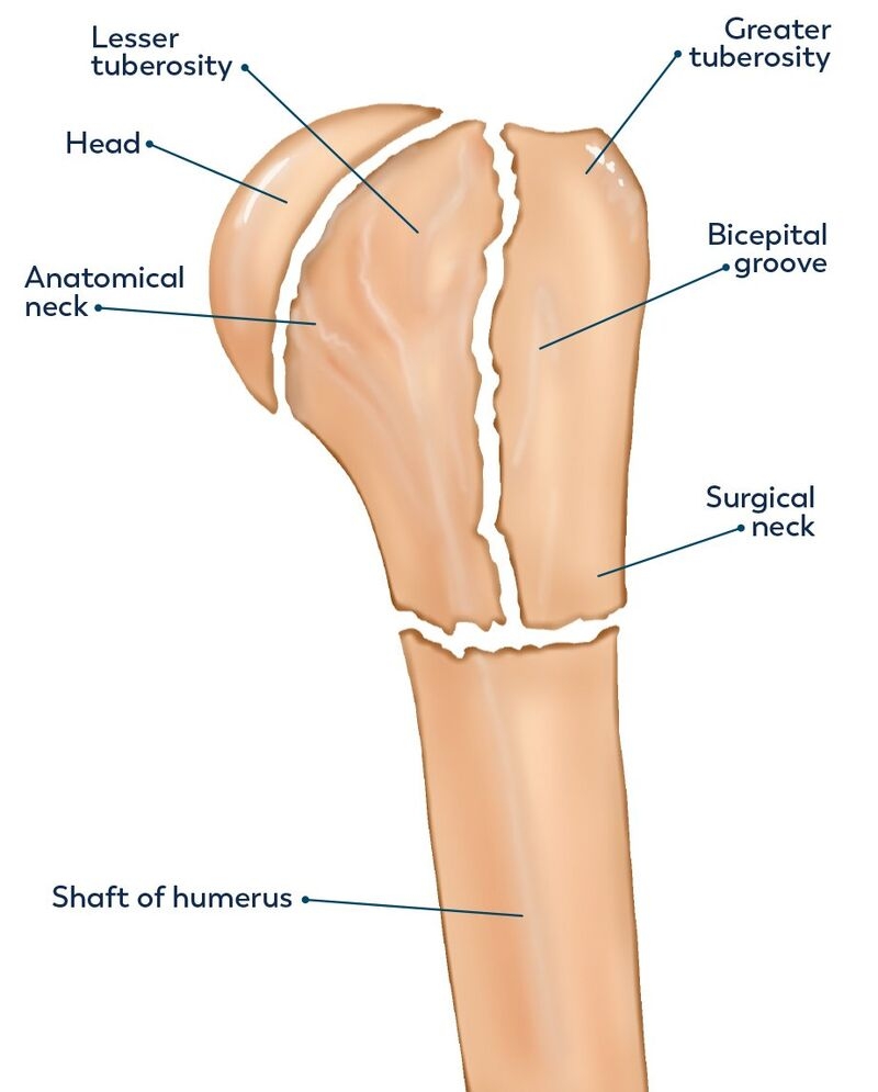 Fractures Of The Humerus Musculoskeletal Key