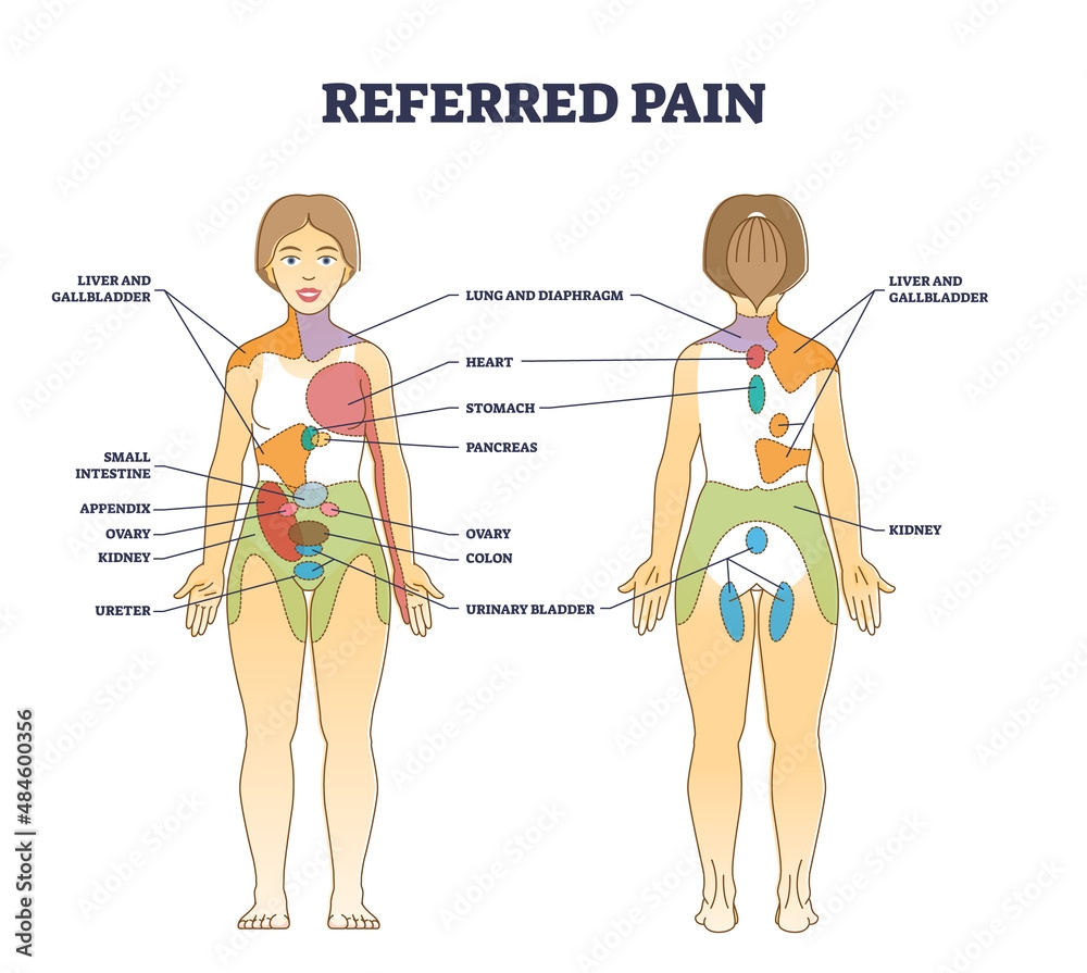 Referred Pain Location As Body Painful Stimulus Organ Origin Outline Diagram Labeled Educational Chart With Problem Zones Projection Vector Illustration Internal Medical Disease Diagnostics Map Stock Vector Adobe Stock
