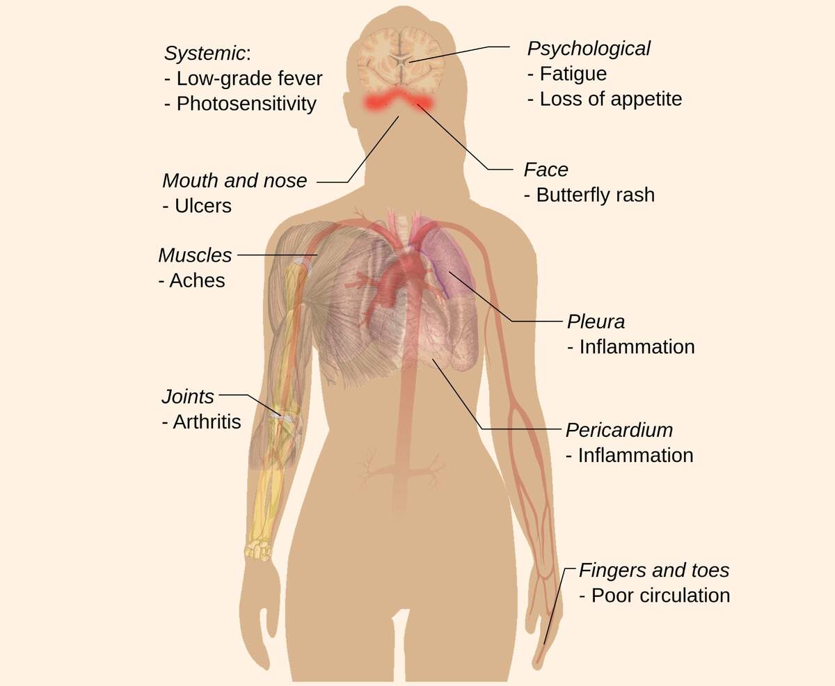 Researchers Identify Potential Cause Of Lupus Sci News