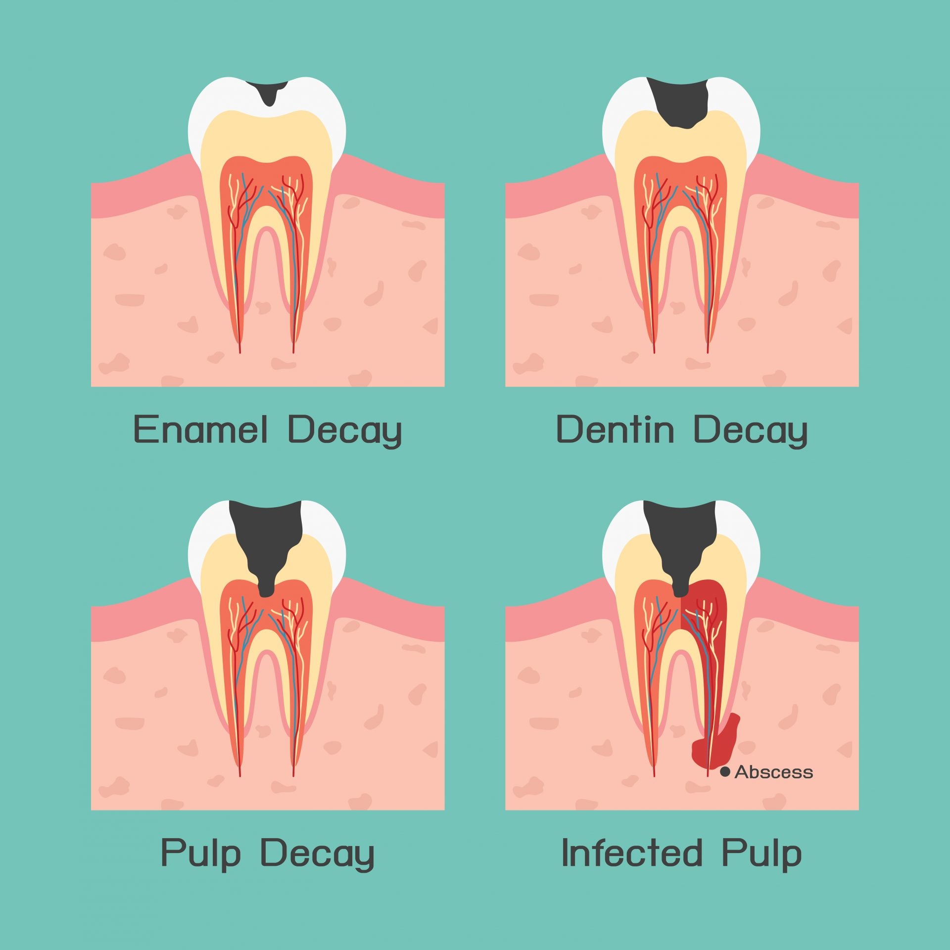 Side Effects Of Root Canal Treatment