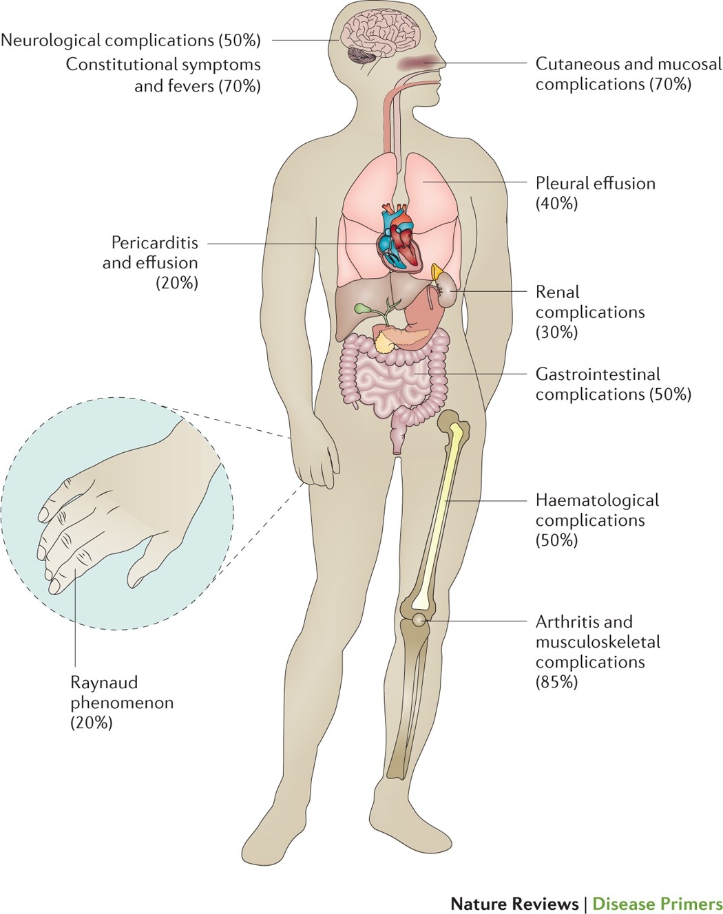 Systemic Lupus Erythematosus Nature Reviews Disease Primers