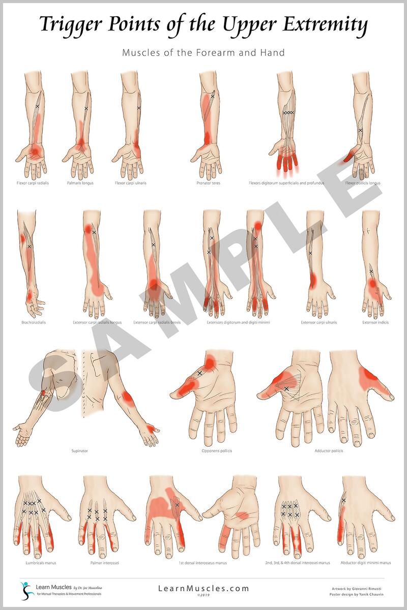 Trigger Point Upper Extremity 24 X 36 Premium Poster 2 Pack Learn Muscles