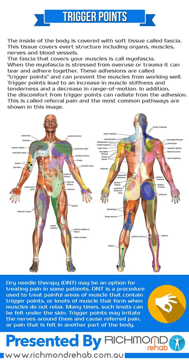 Trigger Points Explained Richmond Rehab Physio Exercise Massage Trigger Points Explained Richmond Rehab Physio Exercise Massage