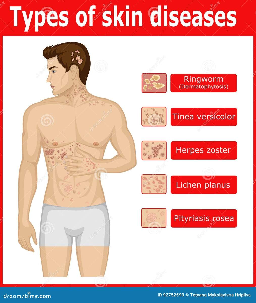Types Of Skin Diseases Stock Vector Illustration Of Herpes 92752593