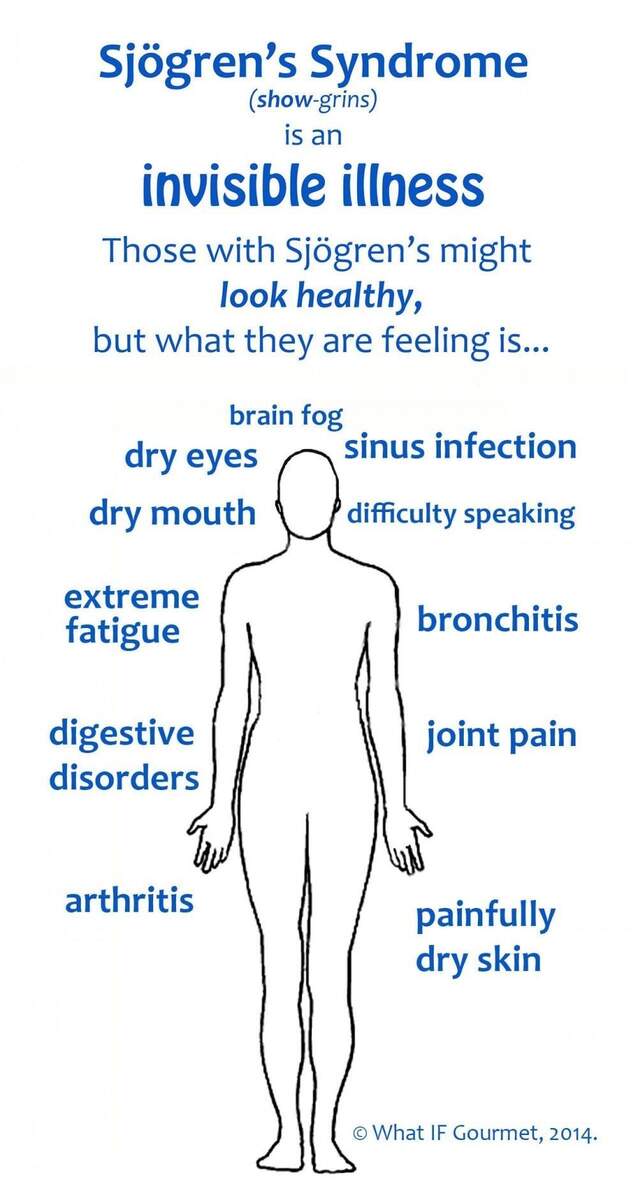 Understanding Sj Gren S Syndrome A Comprehensive Overview Kiran Farheen MD Board Certified Rheumatologists Understanding Sj Gren S Syndrome A Comprehensive Overview Kiran Farheen MD Board Certified Rheumatologists